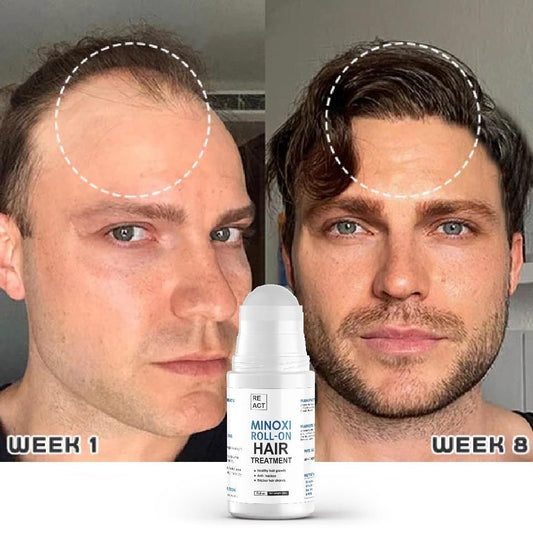 Minoxi Roll-On Hair Treatment – Nourishing Scalp Serum for Fuller, Healthier-Looking Hair