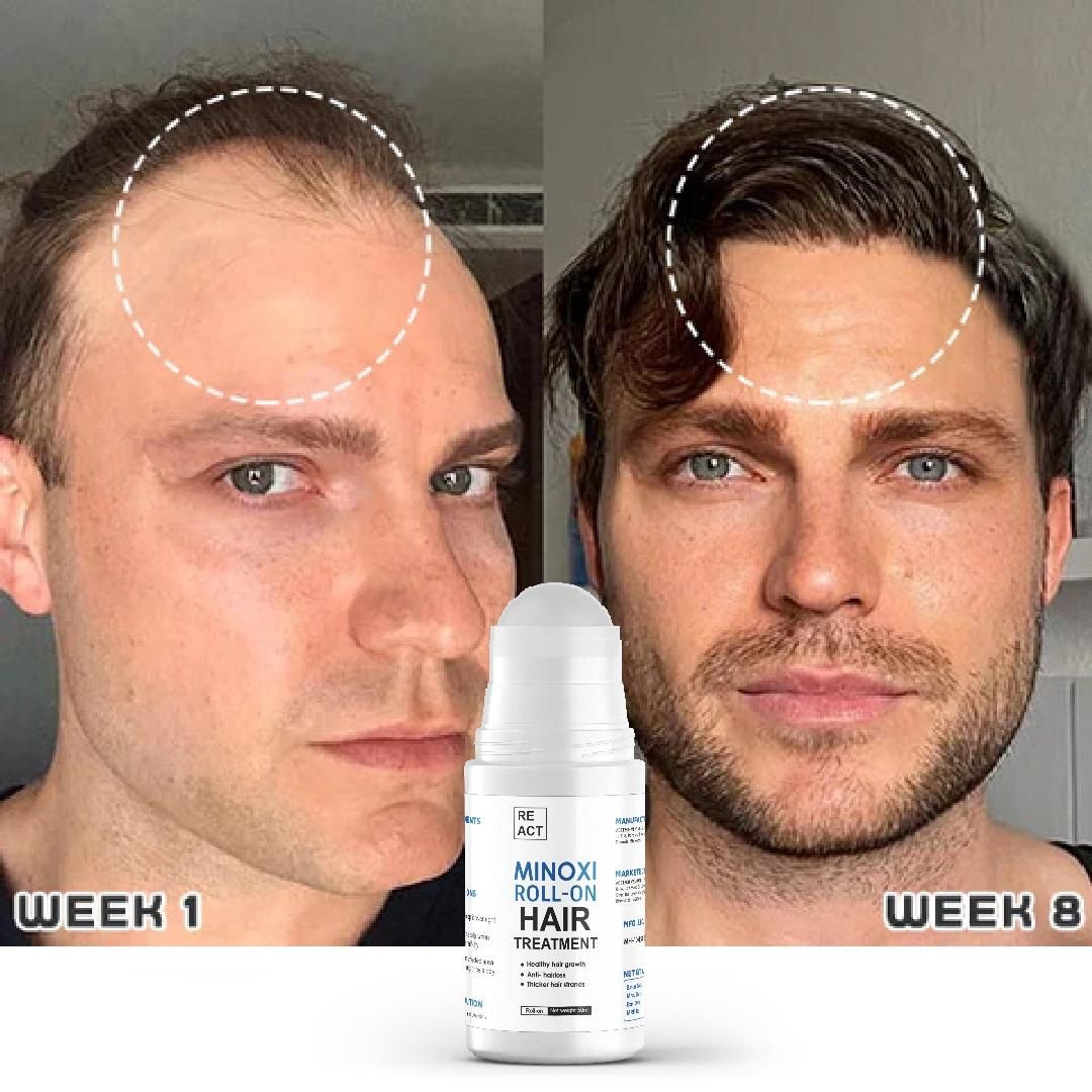 Minoxi Roll-On Hair Treatment – Nourishing Scalp Serum for Fuller, Healthier-Looking Hair